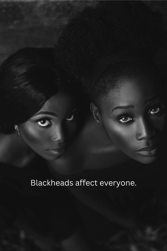 Blackheads are acne in disguise