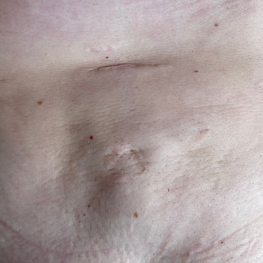 Scrub helps remove scar marks.
