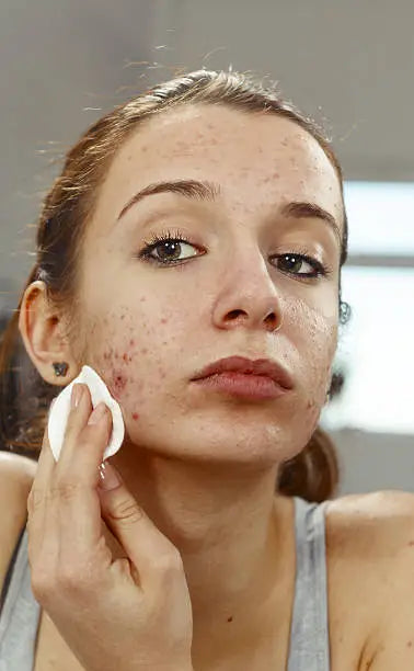 Skincare for acne prone skin