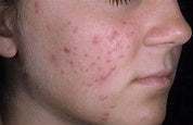 Young skin with acne problem